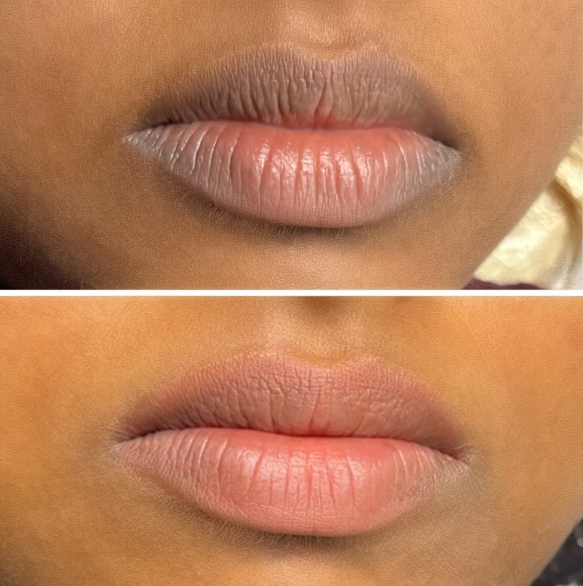 Before and after Dark Lip Neutralisation by Kate Dark