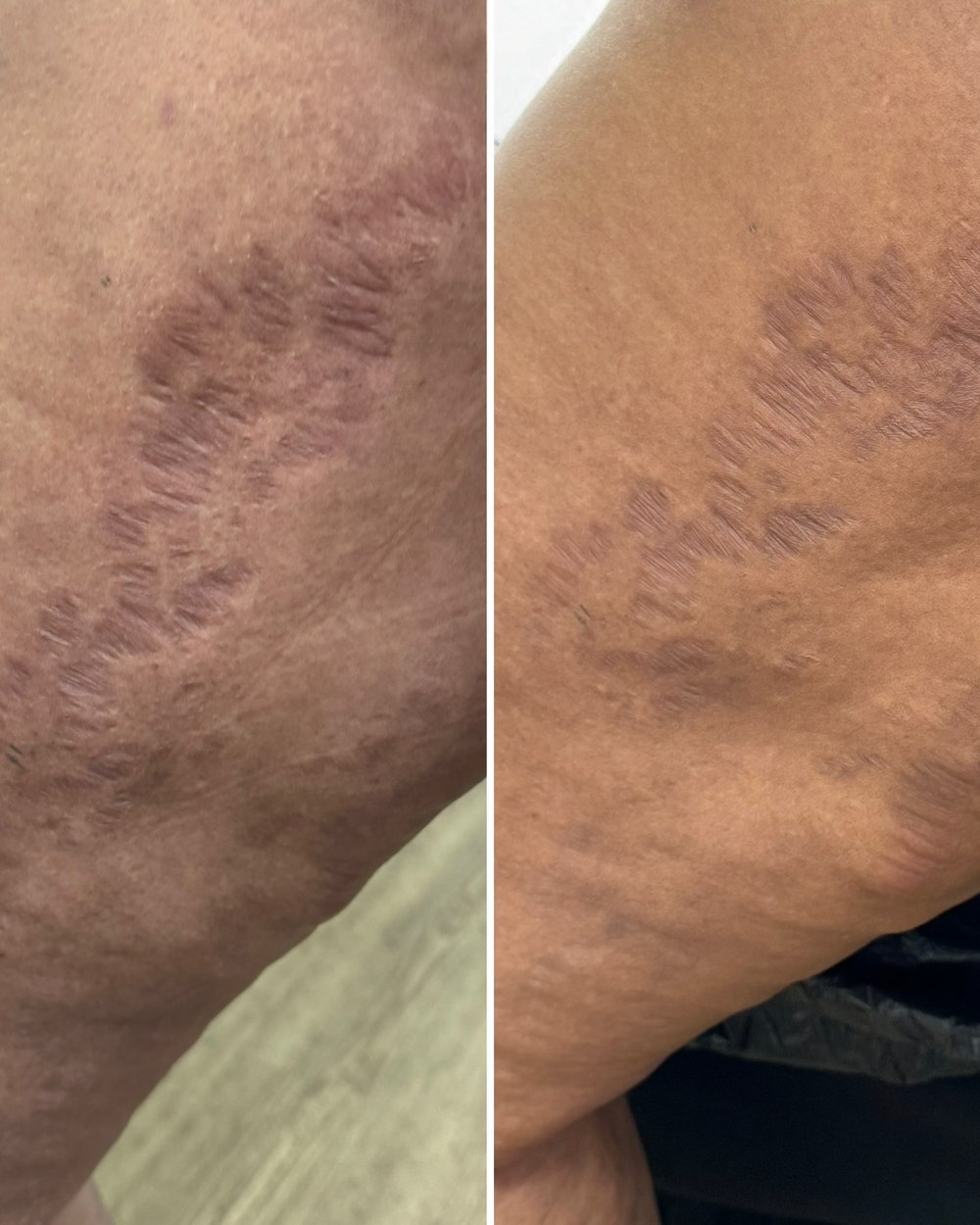 Before and after stretch mark camouflage tattoo by Kate Dark