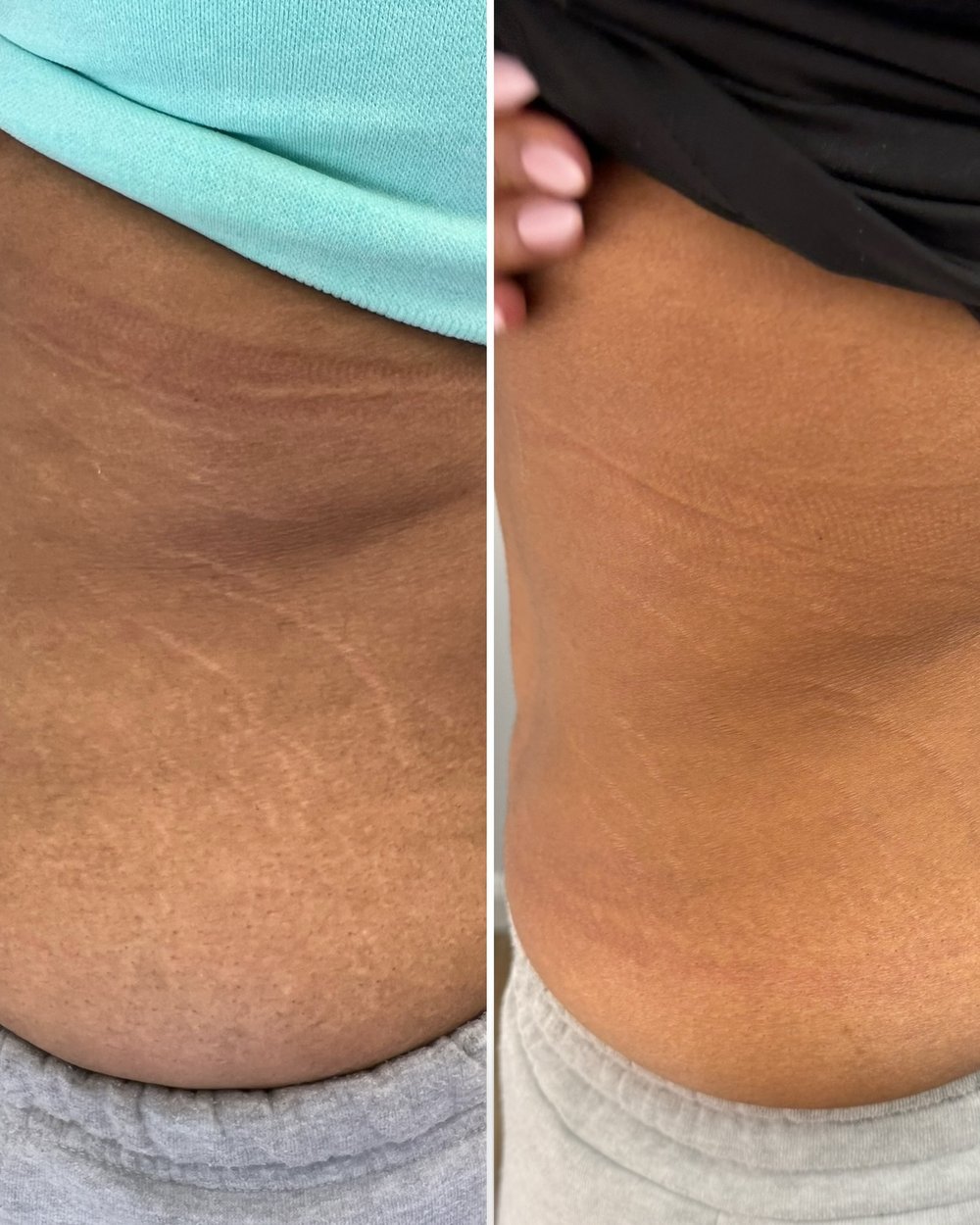 Before and after stretch mark camouflage tattoo by Kate Dark
