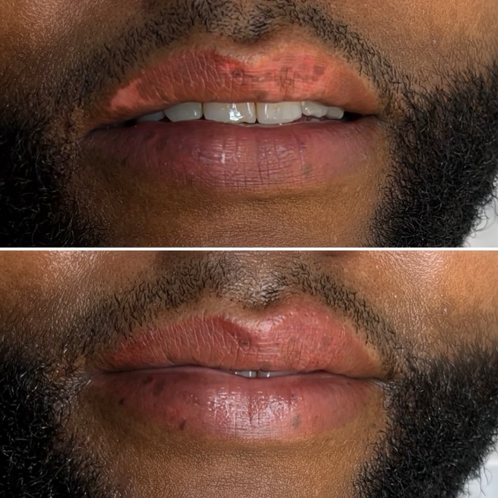 Before and after vitiligo camouflage by Kate Dark