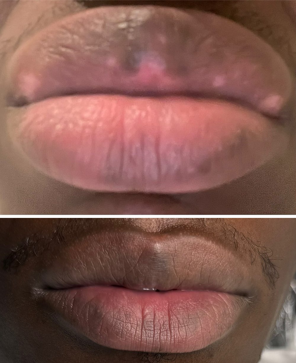 Before and after vitiligo camouflage by Kate Dark